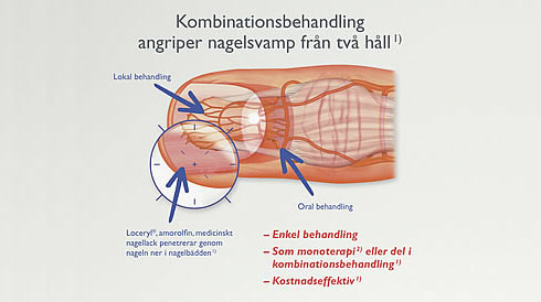 Neglesopp - Galderma Nordic